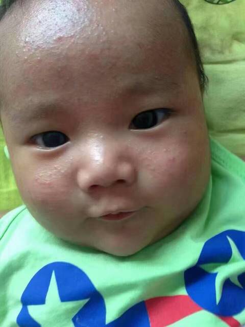 宝宝有湿疹,红屁股,红脖子,过敏的宝妈来找我,我