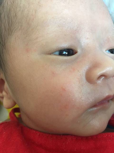 20多天的宝宝脸上起类似粉刺的小疙瘩,还发红