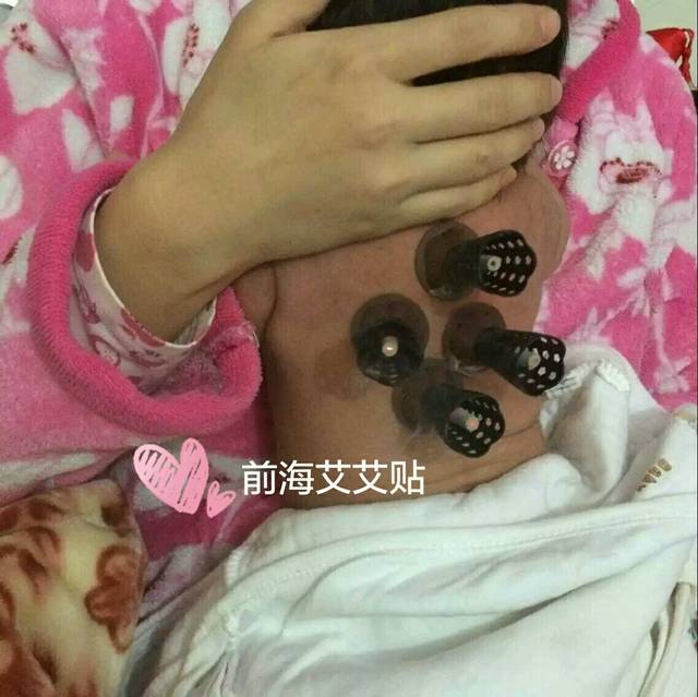 一个月大的宝宝咳嗽怎么办?艾艾贴,效果怎么样