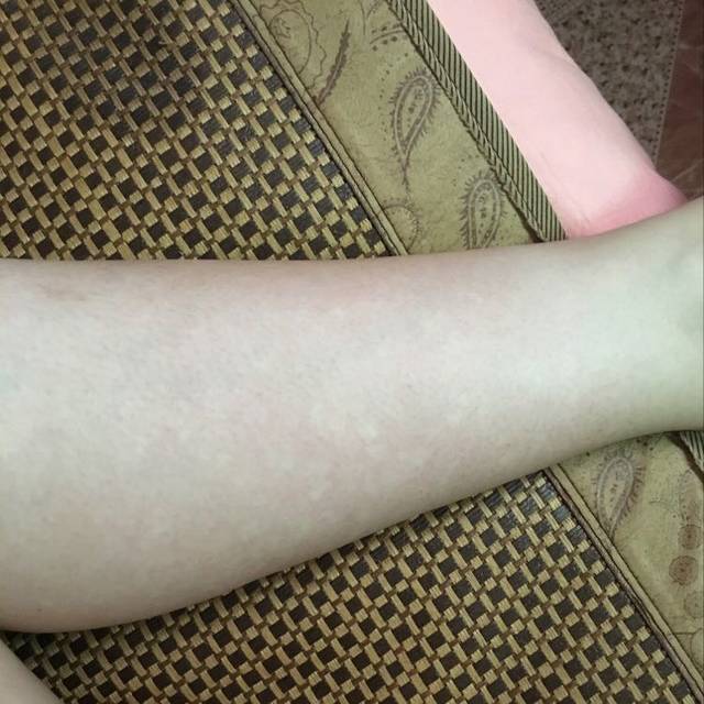 擦完双氧水后出现白点 双氧水擦耳朵