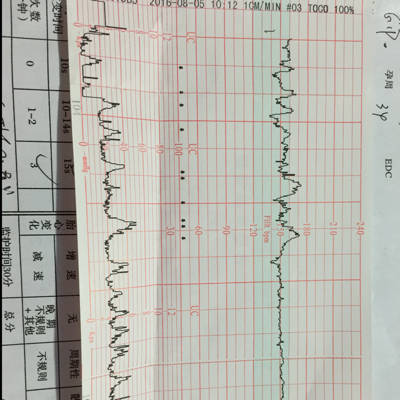 宝妈们帮忙看下胎心监护报告上面的小箭头是什么意思