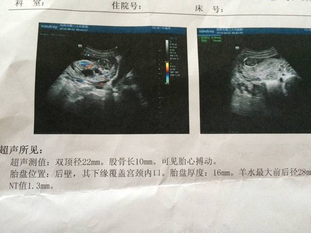 NT通过看看宝宝是坐着还是趴着?_NT通过,自从