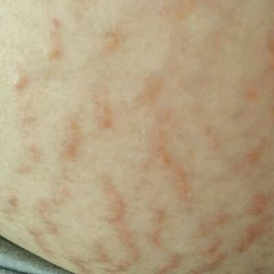 妊娠纹上长满了痘痘,好痒,这是怎么回事,对宝宝