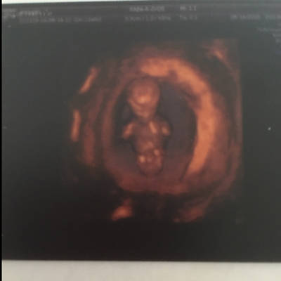 今天NT检查过关,胎儿心跳172,而且说胎盘偏低