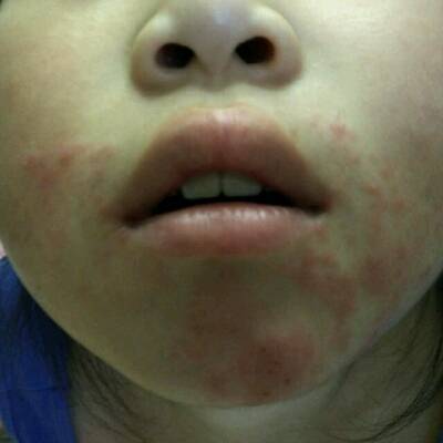 10岁左右,脸上嘴周围有疹子似的红色疙瘩,去医