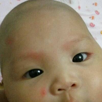 宝宝3个月了脸上有白斑怎么回事?