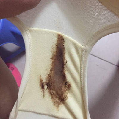 孕34周发现内裤有褐色分泌物,肚子不疼,胎动正