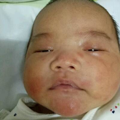 宝宝脸上这样了,有同样问题的宝妈吗?一会睡觉