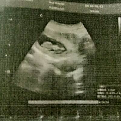怀孕三个月,子宫,体积增大,形态饱满,宫腔可见胎