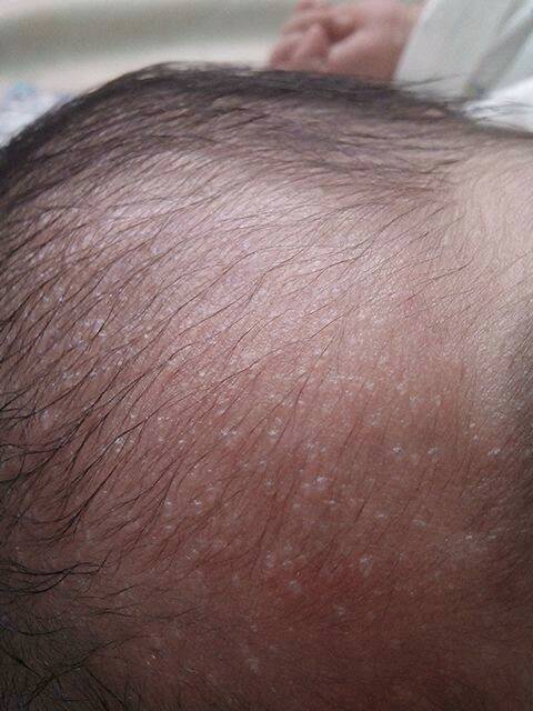 宝宝额头和头上出现了一些像小水痘一样的东西