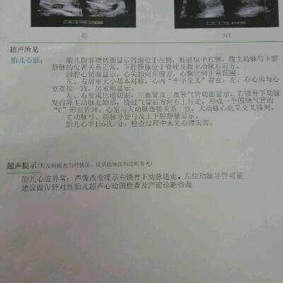 怀孕24周+4,胎儿心脏超声筛查显示:右锁骨下动