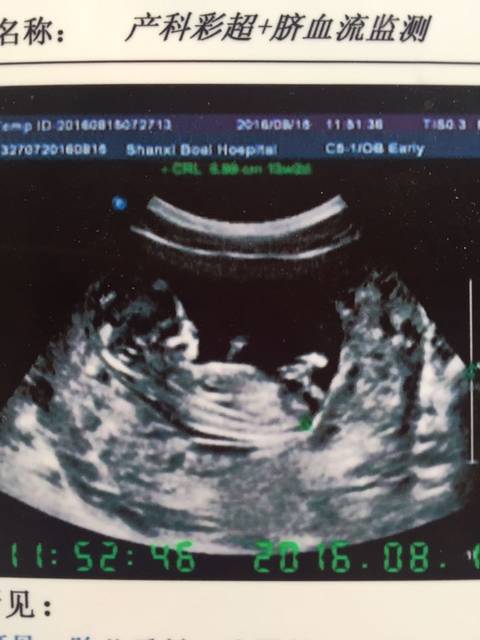 b超图看男女_13周b超图,大家看看是男是女_宝宝树