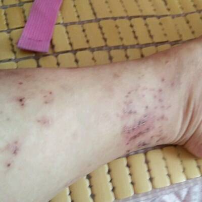 怀孕八个月了,蚊虫把腿咬了挠破了能用双氧水