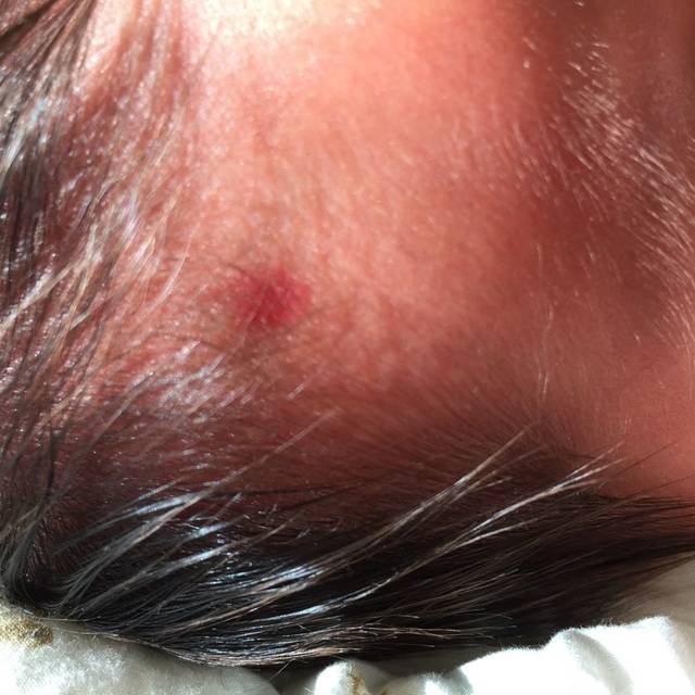 红斑痣_女儿马上满一个月,出生大约十天左右突