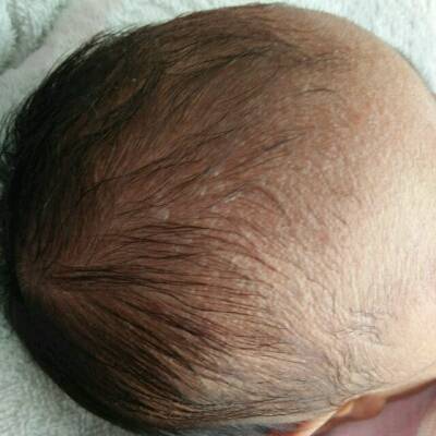 宝宝出生十六天了头上长很多小水泡耳朵后面和