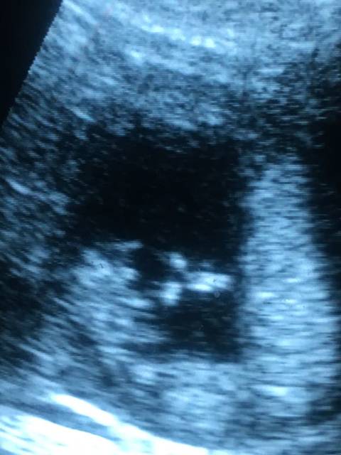 有懂看男女的宝妈帮忙看看12周b超图_本来也没打算查男女,因_宝宝树