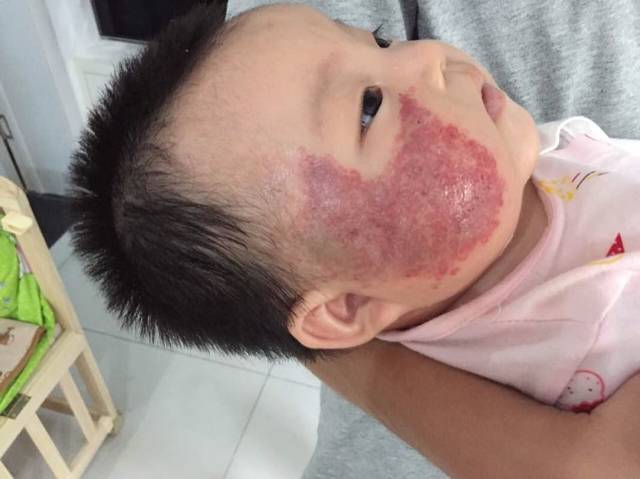 太田痣第一次激光,脸上的疤终于快掉了_一天天绝色视频下载图片