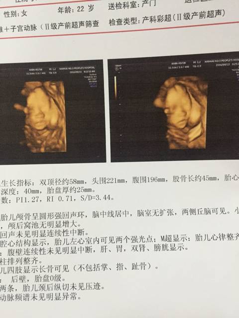 三维彩超已检查_胎儿左心室内可见两个强光点