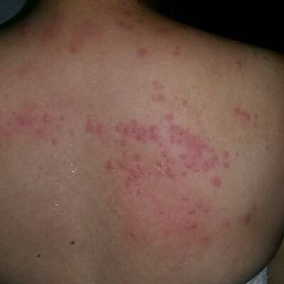 突然之间两天长了好多痒疹,有没有宝妈遇到同样的情况