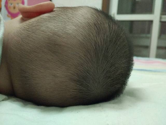 [头型正常么]_3月龄体检,说宝宝囟门小,建议去