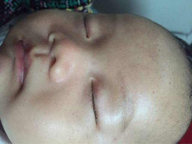 !起这种是什么?_ !宝宝脸上突然气红点点不是痘