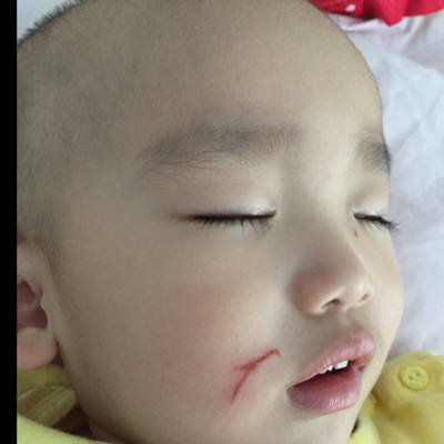 我家宝宝1岁8个月,被小女孩划伤脸,结疤后不小