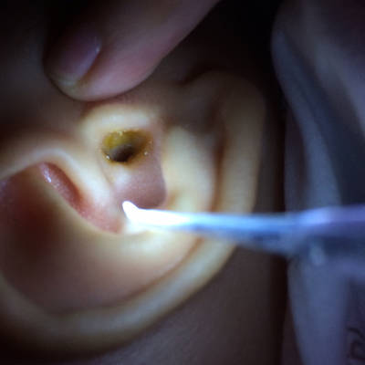 前段时间偶然感觉宝宝右耳朵有味道,以为是婴儿新陈代谢快有耳屎的