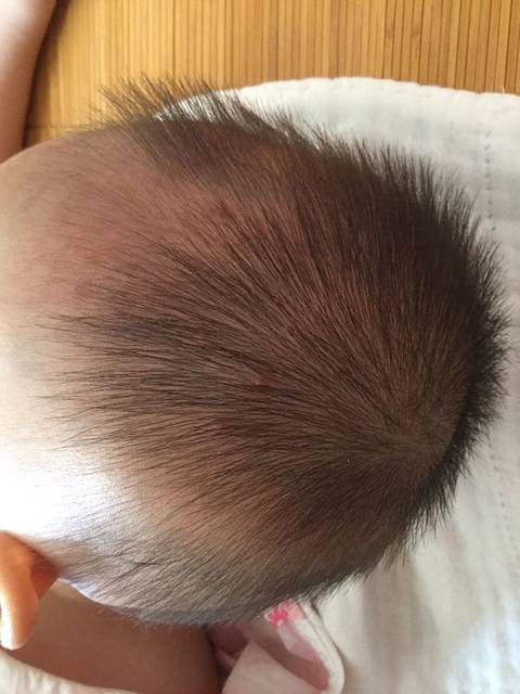 宝宝头上长痘痘反反复复的不见好_宝宝现在八