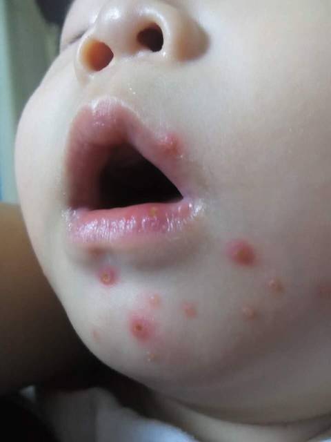 有没有宝妈知道孩子长的是疱疹吗