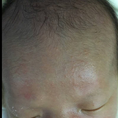 宝宝额头跟脸上长了一粒一粒的像痘痘的是什么