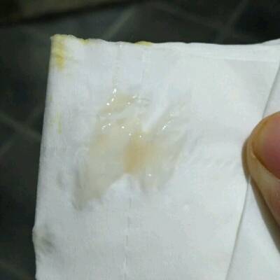 31周内裤上有褐色痕迹,分泌物不透明,有点点颜