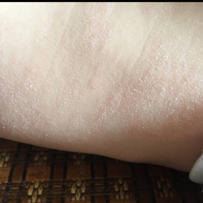 皮肤有一粒粒的样子像鸡皮疙瘩摸上去很粗糙,请问是干性湿疹吗?