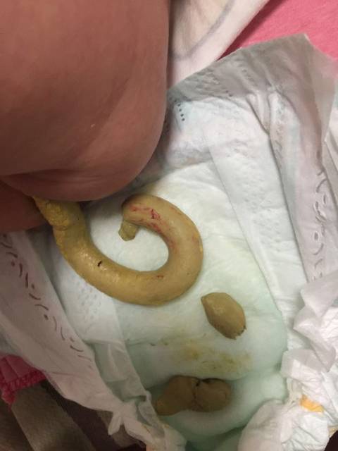 有图!宝宝大便干有血!_两个月宝宝拉大便很吃