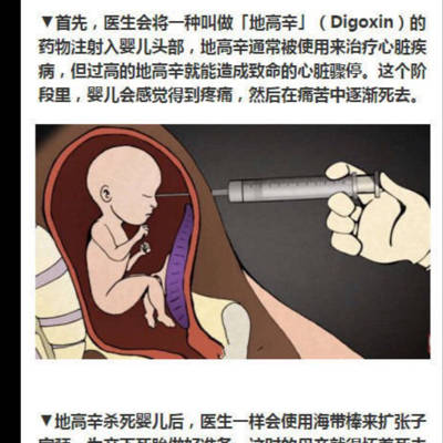 给要引产的宝妈看看,怎么忍心?有图慎点!