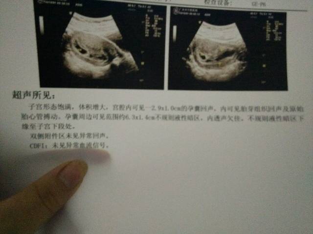 宫腔积液_怀孕早期孕囊周边可见范围约6.3*10