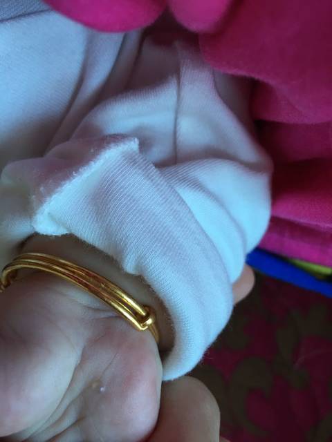 这是怎么回事,有知道的吗_女儿手上这样小水泡