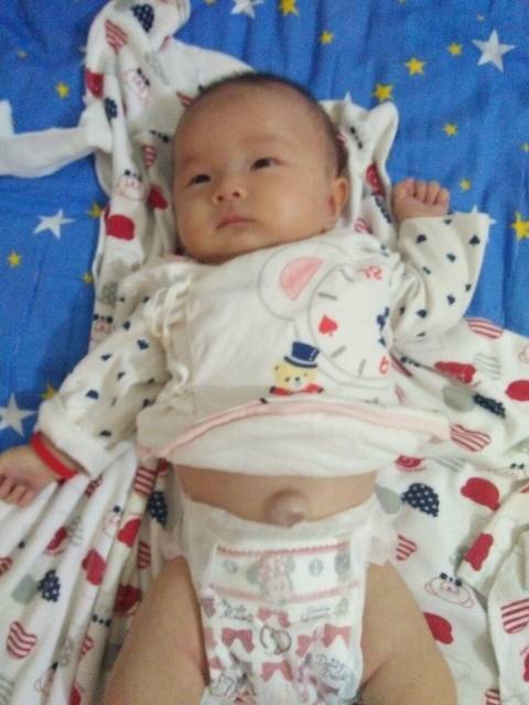 宝宝脐疝_我家宝宝45天,从35天就有脐疝,有和