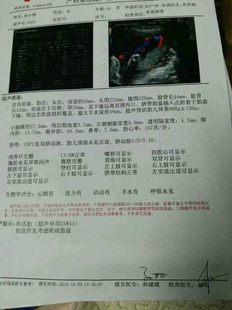 3维彩超宝宝一切正常,但说考虑帆状胎盘,有懂