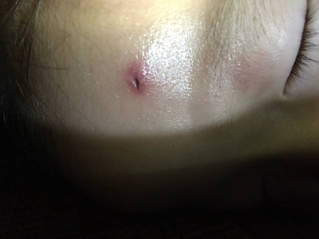 宝宝摔伤后留有黑色印子怎么办?_宝宝摔了跤