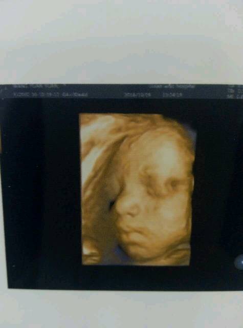 30周四维彩超_老公说宝宝眼睛旁边有个窝窝