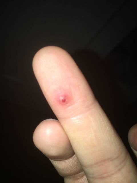 孕期手指血管瘤?_大家看看有没有好办法可以