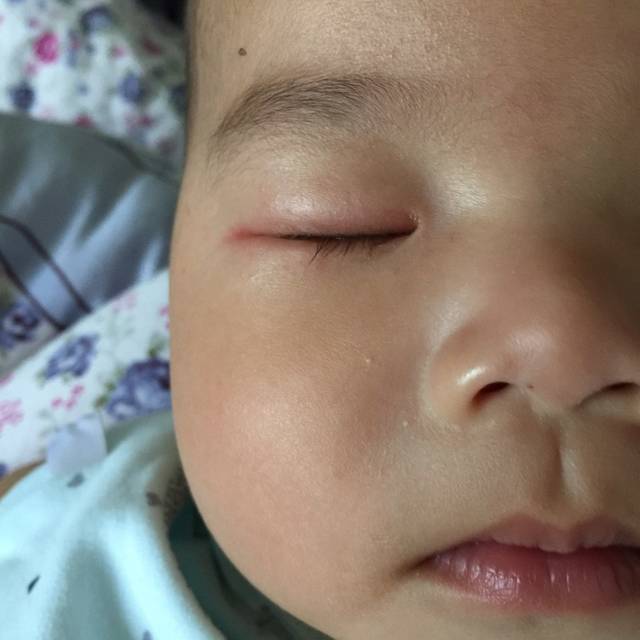 宝宝眼睛肿了_宝宝前几天右眼一直有眼泪,后来