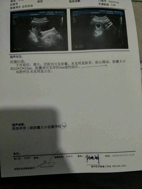 医生说显示胚胎停育_今天下午彩超显示7周,孕