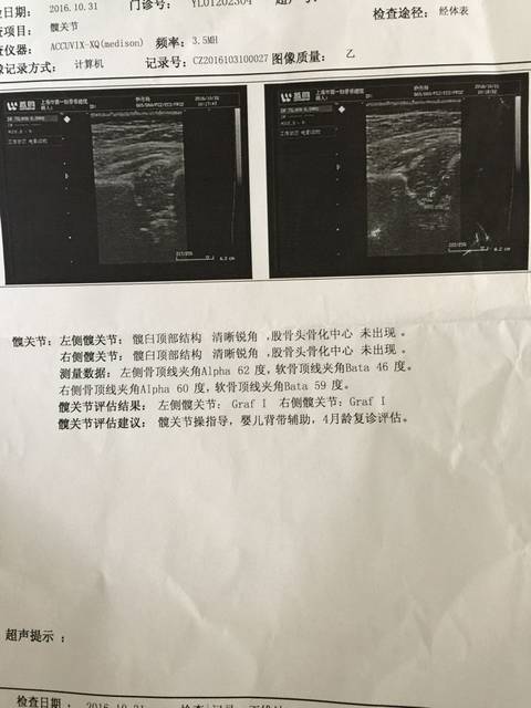 上海博爱医院_宝宝2个月了,体检说髋宽节发育