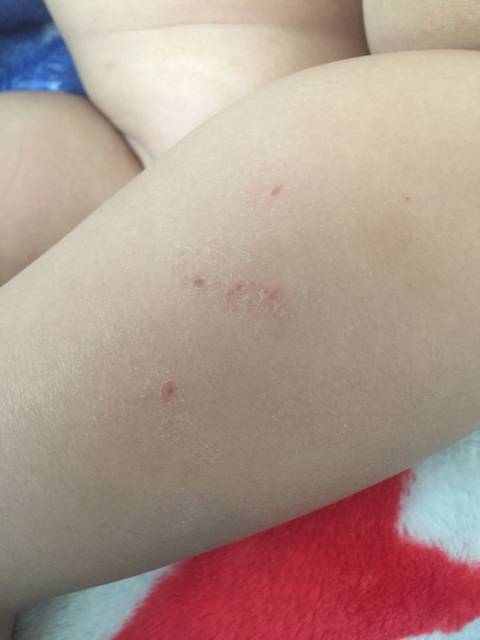 我儿子身上起的什么呀?谢谢大家帮忙看看_胳