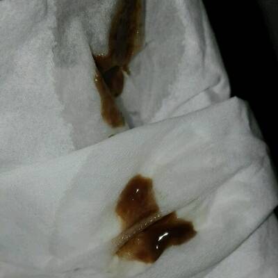 流一点褐色分泌物卧床休息三天没有了过两天怎么又有一点点?如图