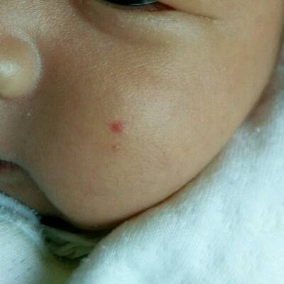 宝宝20 几天了,脸上突然长了两颗像被蚊子咬的