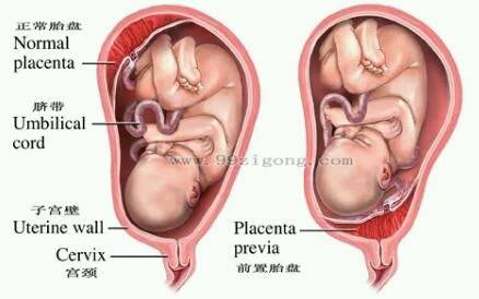 三胞胎怀孕四个月,胎盘低置出血,如何保胎_三