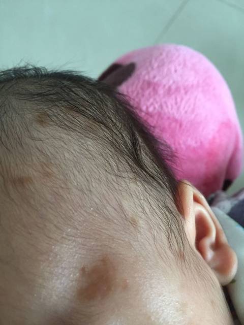 这是怎么了_宝宝身上头上长了好多褐色斑,这是