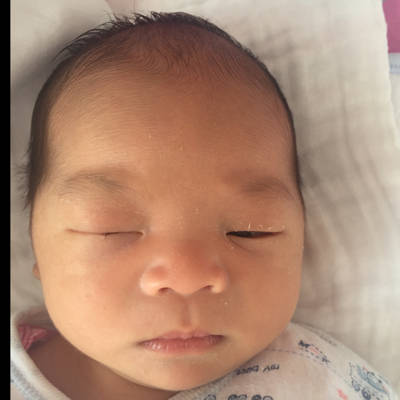 宝宝出生10天,经常左眼黄色眼屎分泌物,把眼睫